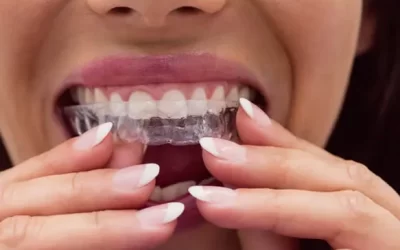 Invisalign Atlanta: Clear Aligner Therapy for Discreet Orthodontic Correction